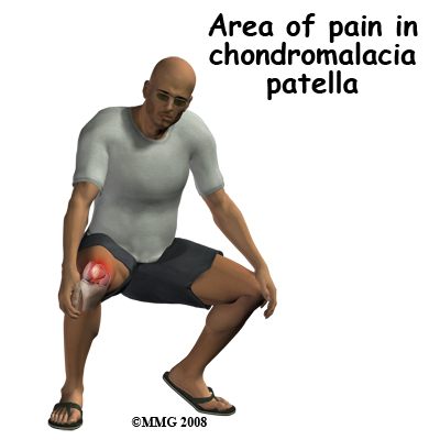 knee chondromalacia symptom1